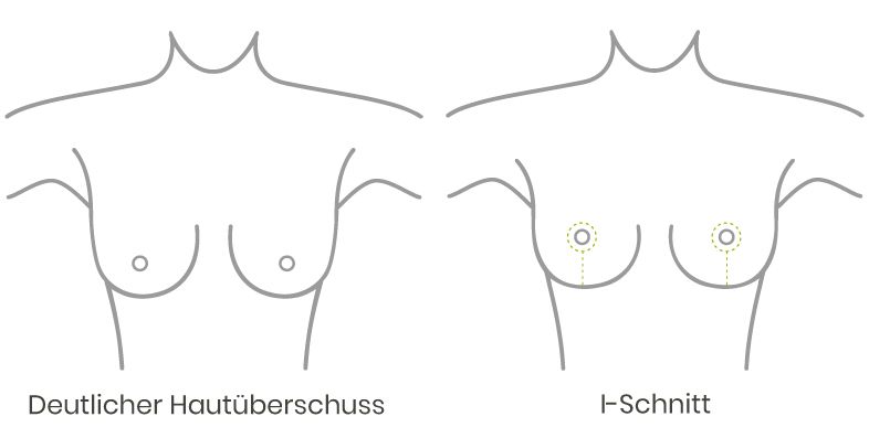 Skizze Brustverkleinerung i-Schnitt