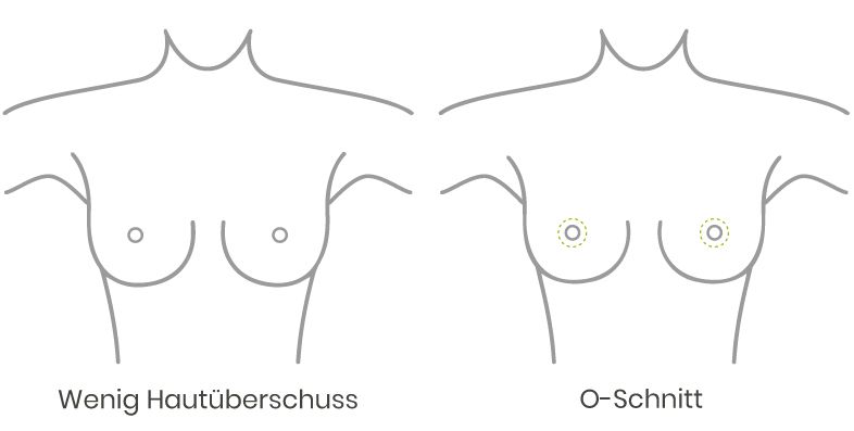 Skizze Brustverkleinerung O-Schnitt