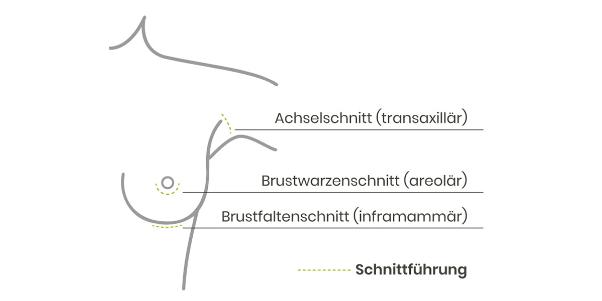 OP Methoden Brustvergrößerung