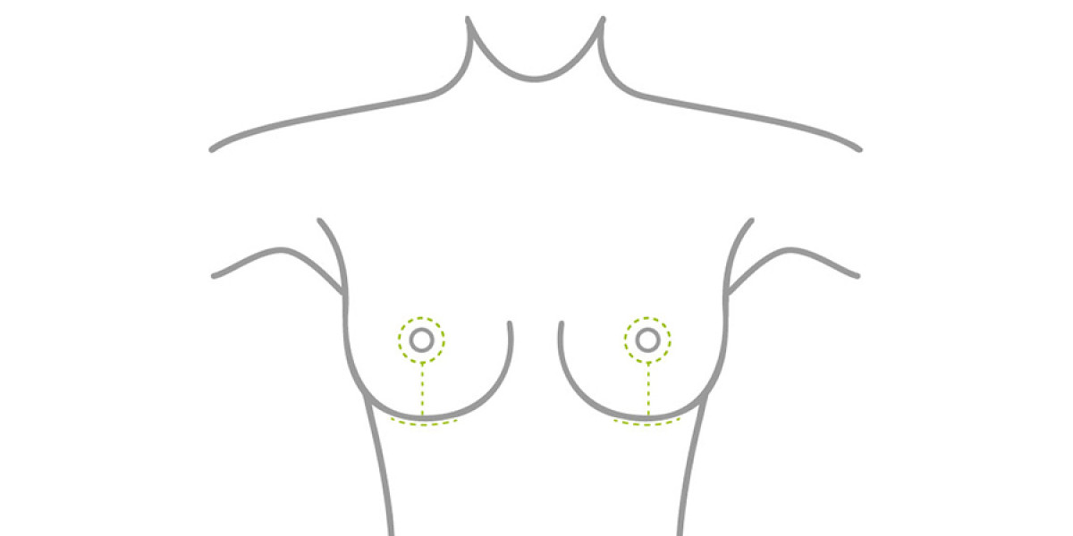Narbenverlauf bei einer Bruststraffung oder Brustverkleinerung