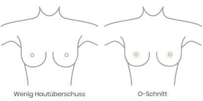 wenig Hautüberschuss vor einer Bruststraffung oder Brustverkleinerung