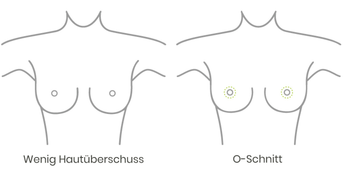 wenig Hautüberschuss vor einer Bruststraffung oder Brustverkleinerung