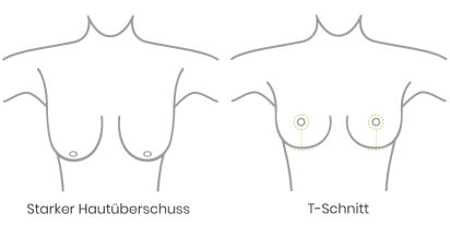 starker Hautüberschuss vor einer Bruststraffung oder Brustverkleinerung