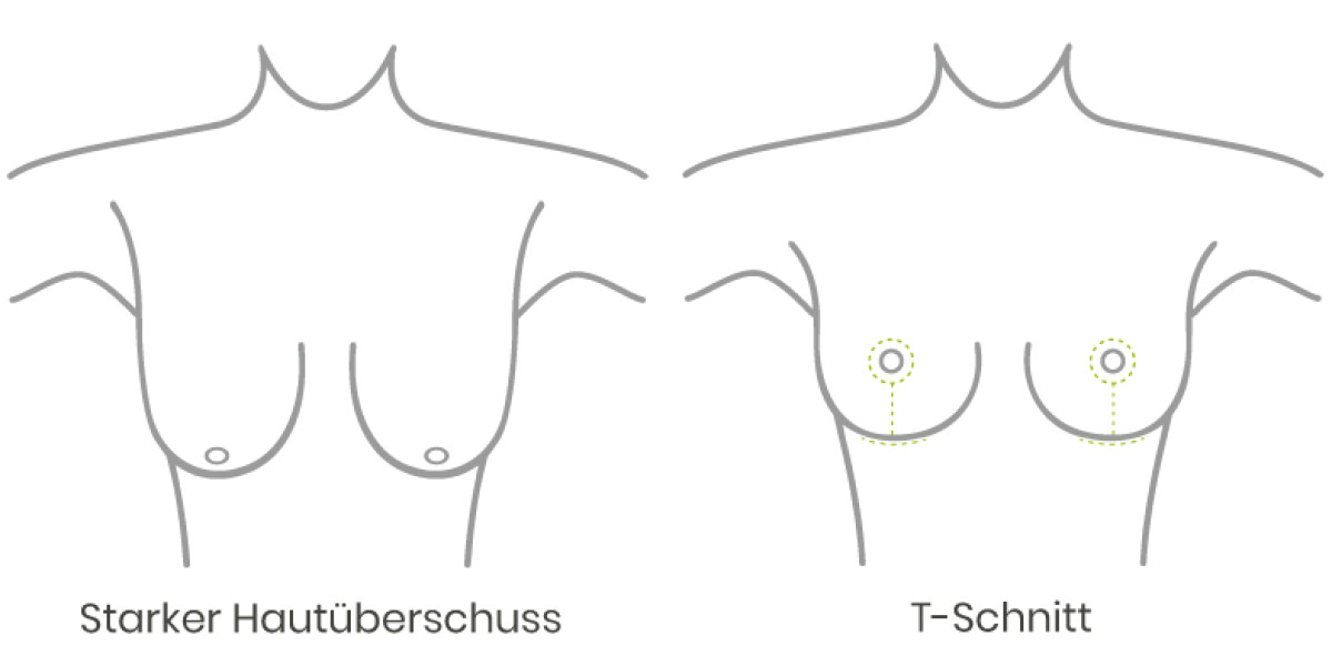 starker Hautüberschuss vor einer Bruststraffung oder Brustverkleinerung