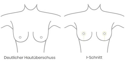 deutlicher Hautüberschuss vor einer Bruststraffung oder Brustverkleinerung
