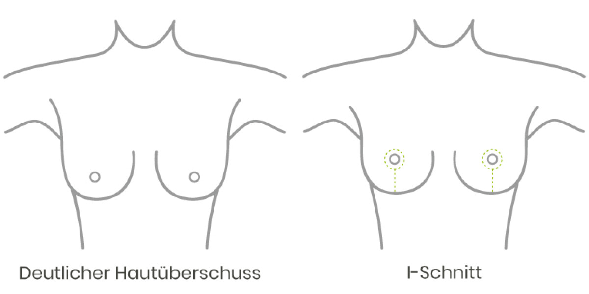 deutlicher Hautüberschuss vor einer Bruststraffung oder Brustverkleinerung