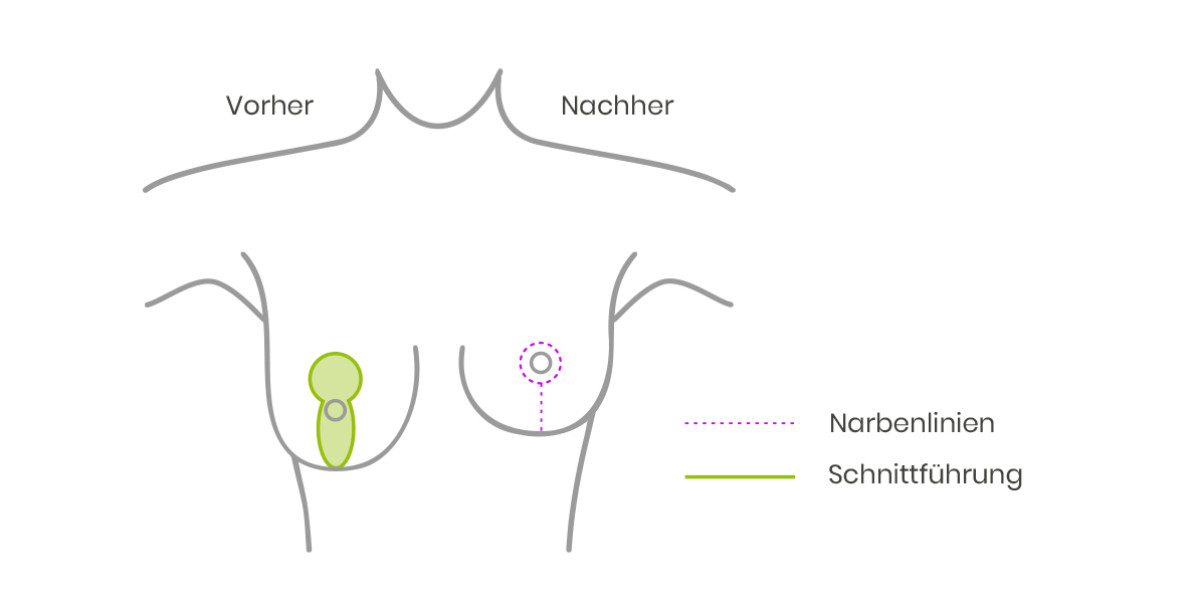 Brustverkleinerung - Bruststraffung Vorher Nachher Bilder